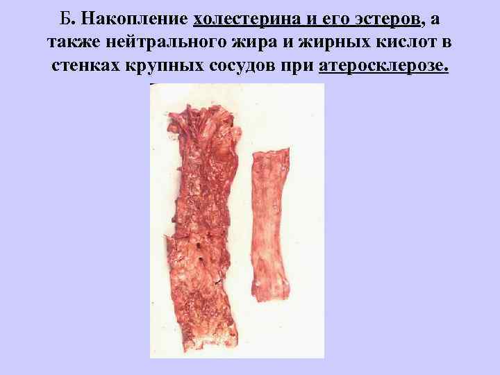  Б. Накопление холестерина и его эстеров, а также нейтрального жира и жирных кислот