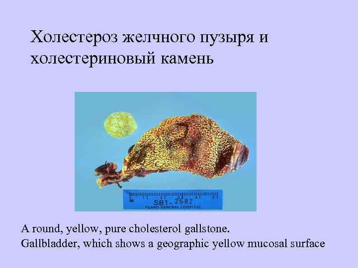  Холестероз желчного пузыря и  холестериновый камень А round, yellow, pure cholesterol gallstone.