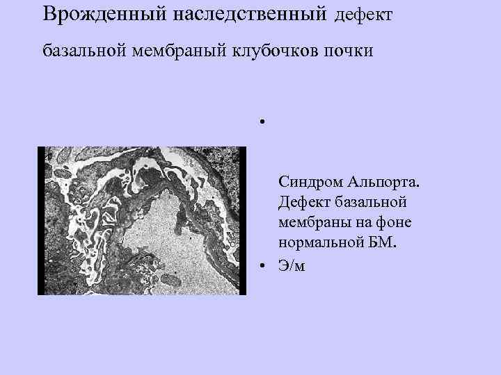 Врожденный наследственный дефект базальной мембраный клубочков почки      • Defective