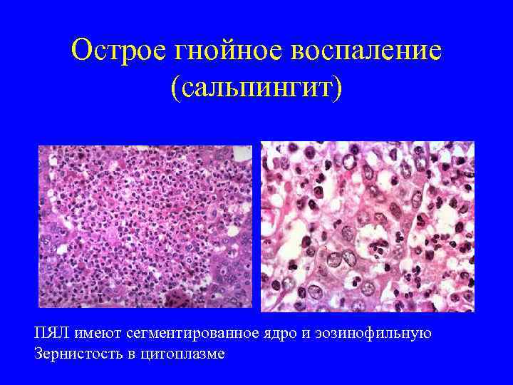   Острое гнойное воспаление   (сальпингит) ПЯЛ имеют сегментированное ядро и эозинофильную