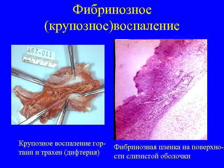   Фибринозное   (крупозное)воспаление Крупозное воспаление гор-  Фибринозная пленка на поверхно-