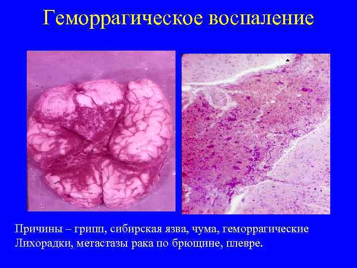  Геморрагическое воспаление Причины – грипп, сибирская язва, чума, геморрагические Лихорадки, метастазы рака по