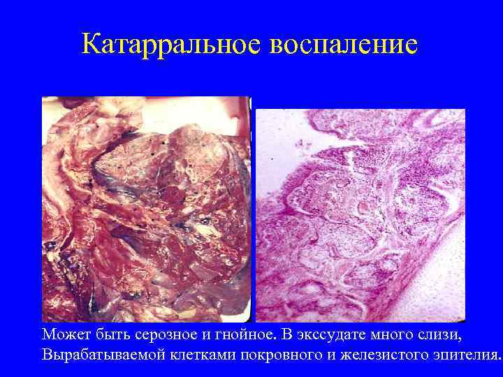   Катарральное воспаление Может быть серозное и гнойное. В экссудате много слизи, 