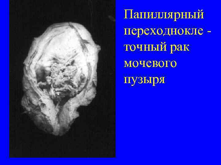Папиллярный переходнокле - точный рак мочевого пузыря 