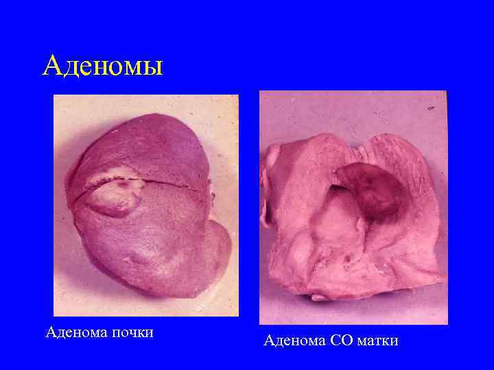 Аденомы Аденома почки  Аденома СО матки 