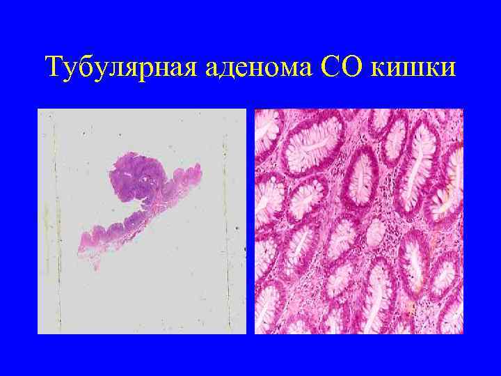 Тубулярная аденома СО кишки 