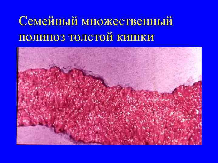 Семейный множественный полипоз толстой кишки 