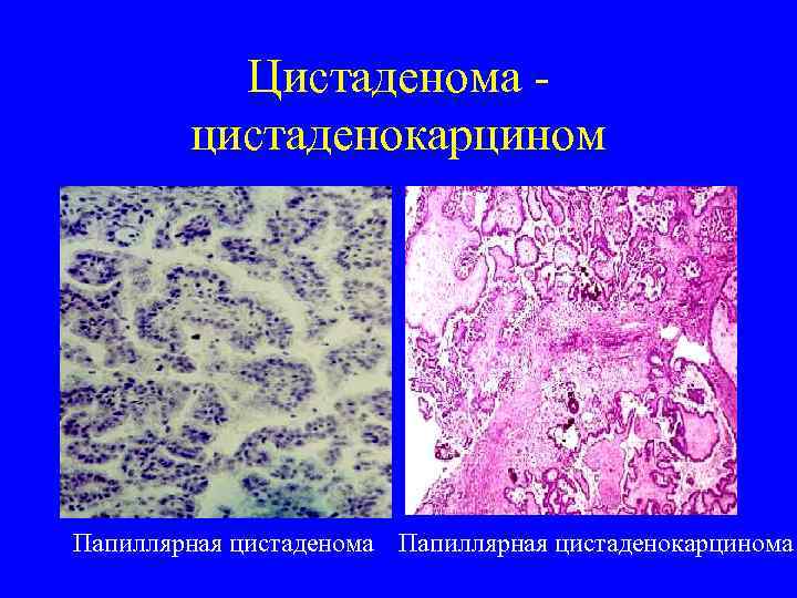    Цистаденома -   цистаденокарцином Папиллярная цистаденома Папиллярная цистаденокарцинома 