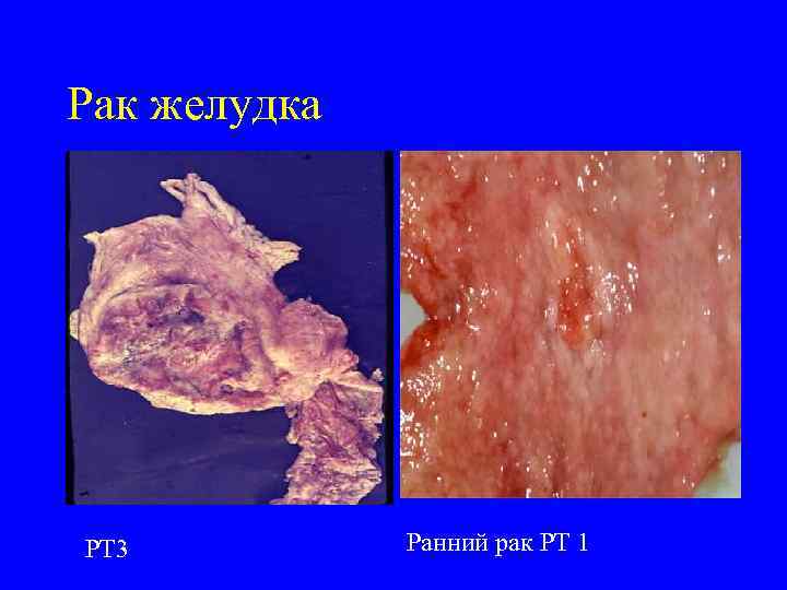 Рак желудка РТ 3  Ранний рак РТ 1 