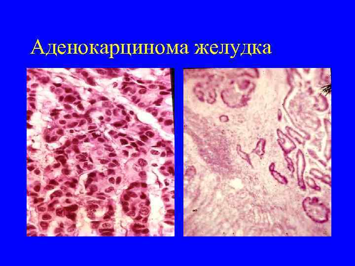 Аденокарцинома желудка 