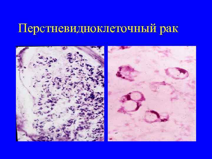 Перстневидноклеточный рак 