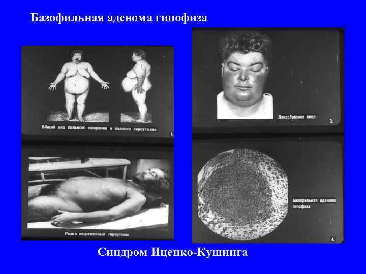 Базофильная аденома гипофиза    Синдром Иценко-Кушинга 