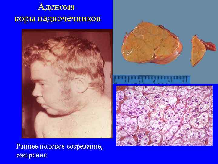  Аденома коры надпочечников Раннее половое созревание, ожирение 