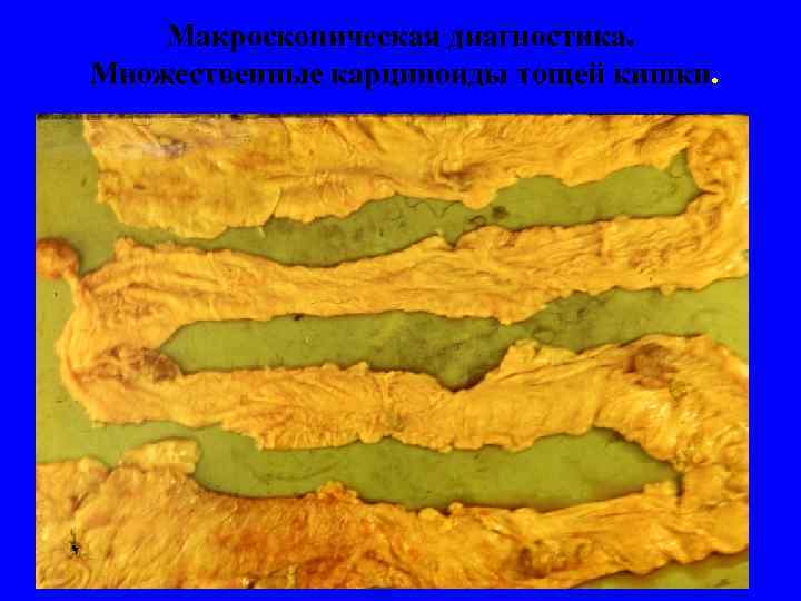  Макроскопическая диагностика.  Множественные карциноиды тощей кишки. 