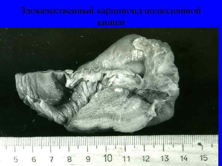 Злокачественный карциноид подвздошной   кишки 