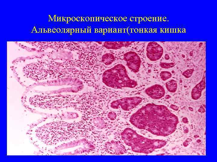   Микроскопическое строение. Альвеолярный вариант(тонкая кишка 
