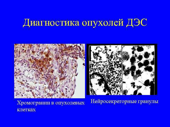  Диагностика опухолей ДЭС Хромогранин в опухолевых  Нейросекреторные гранулы клетках 