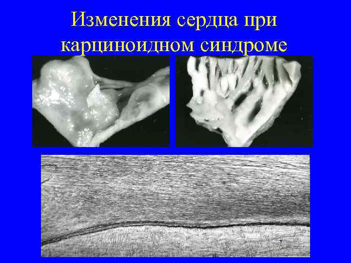  Изменения сердца при карциноидном синдроме 