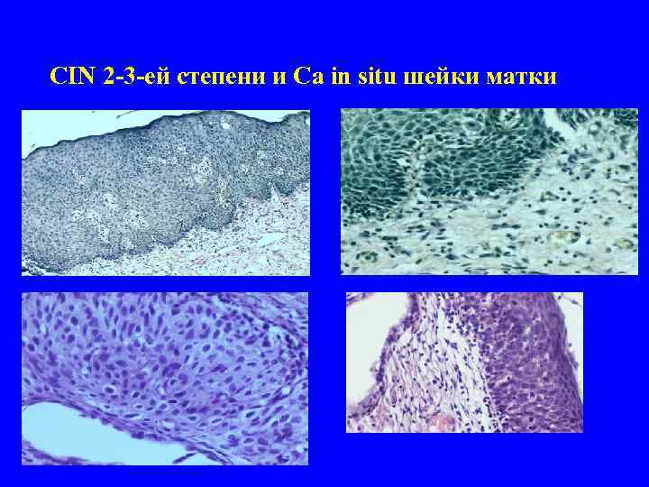 CIN 2 -3 -ей степени и Ca in situ шейки матки 