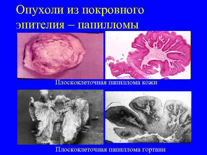 Опухоли из покровного эпителия – папилломы   Плоскоклеточная папиллома кожи  Плоскоклеточная папиллома