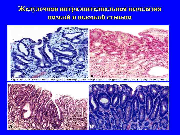 Желудочная интраэпителиальная неоплазия   низкой и высокой степени 