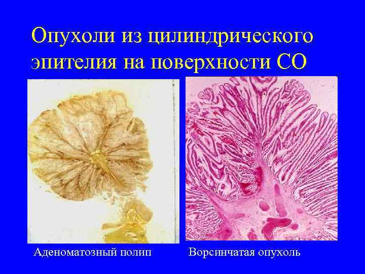 Опухоли из цилиндрического эпителия на поверхности СО Аденоматозный полип  Ворсинчатая опухоль 