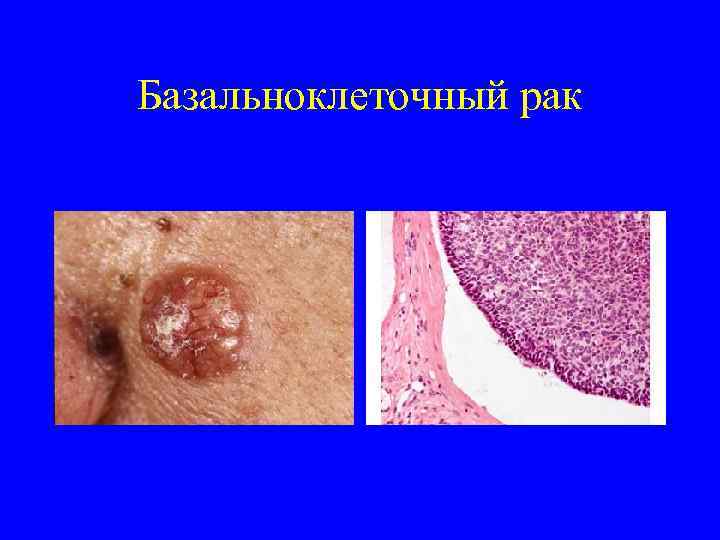 Базальноклеточный рак 