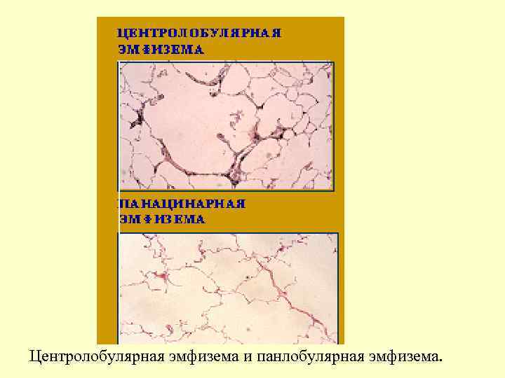 Центролобулярная эмфизема и панлобулярная эмфизема. 
