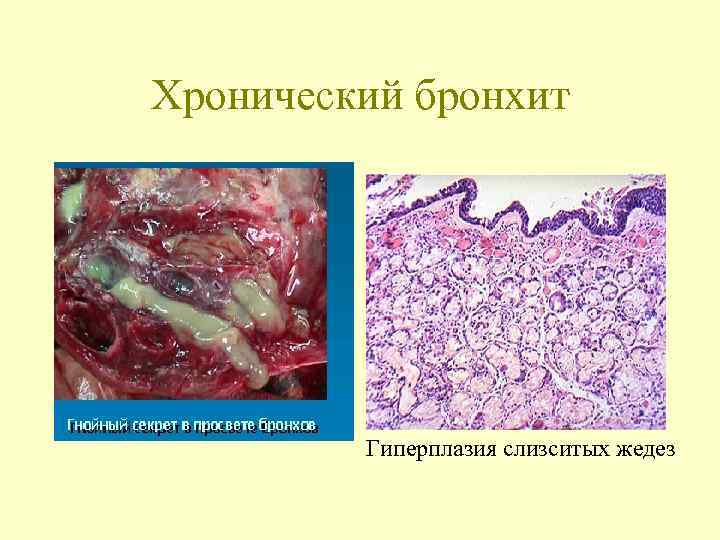 Хронический бронхит    Гиперплазия слизситых жедез 