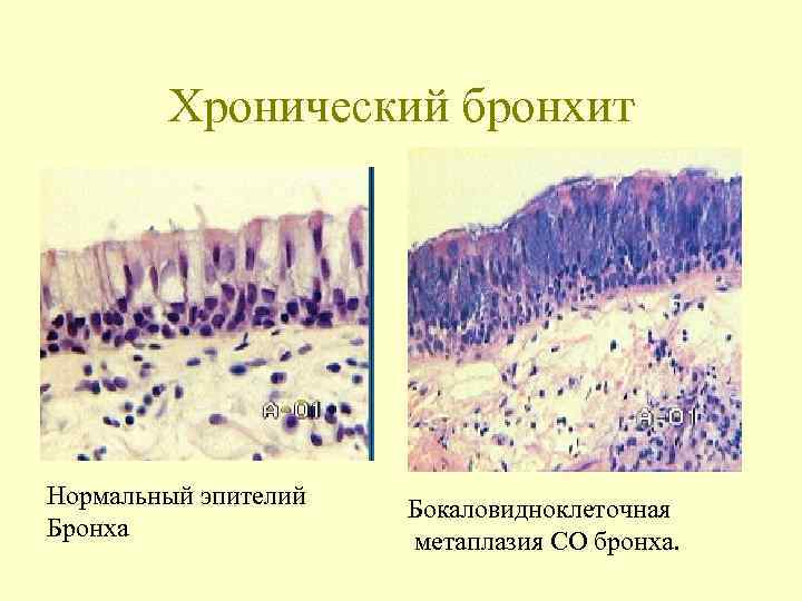    Хронический бронхит Нормальный эпителий  Бокаловидноклеточная Бронха   метаплазия СО