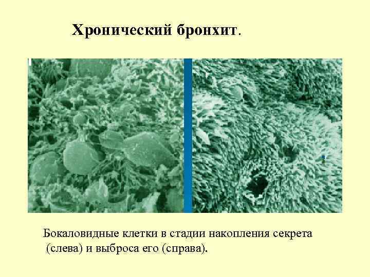  Хронический бронхит. Бокаловидные клетки в стадии накопления секрета (слева) и выброса его (справа).