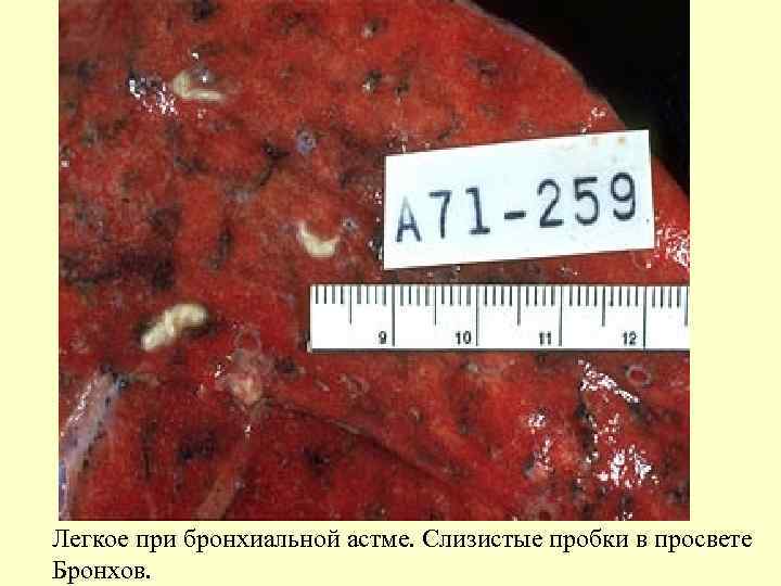 Легкое при бронхиальной астме. Слизистые пробки в просвете Бронхов. 