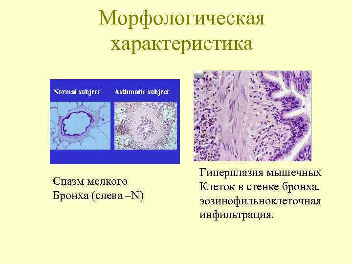   Морфологическая  характеристика     Гиперплазия мышечных Спазм мелкого 