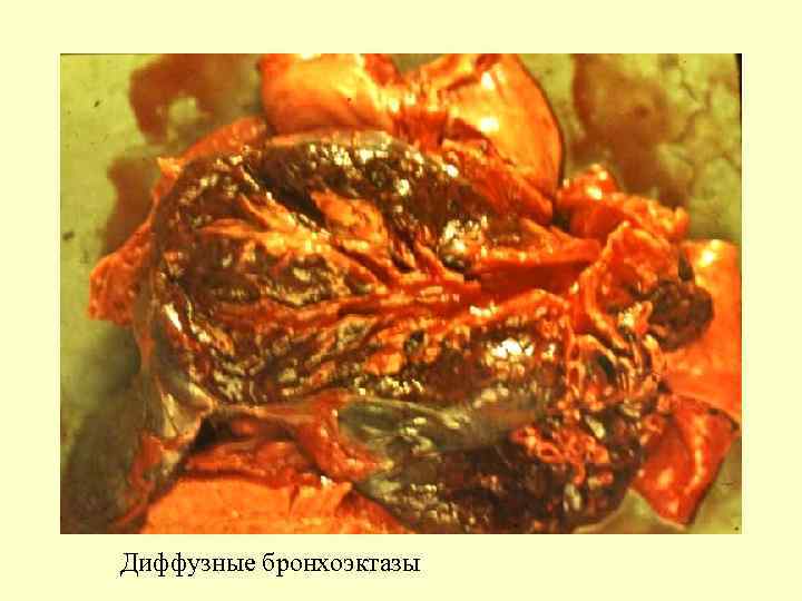  Диффузные бронхоэктазы 