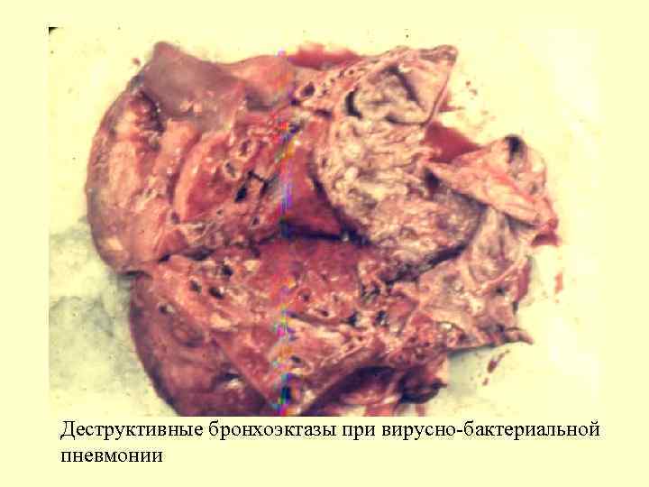 Деструктивные бронхоэктазы при вирусно-бактериальной пневмонии 