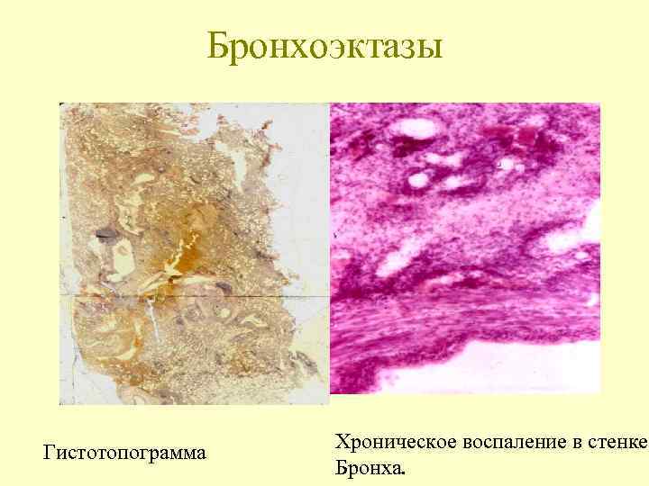    Бронхоэктазы     Хроническое воспаление в стенке Гистотопограмма 