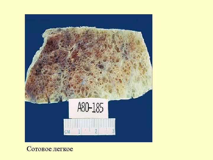 Сотовое легкое 
