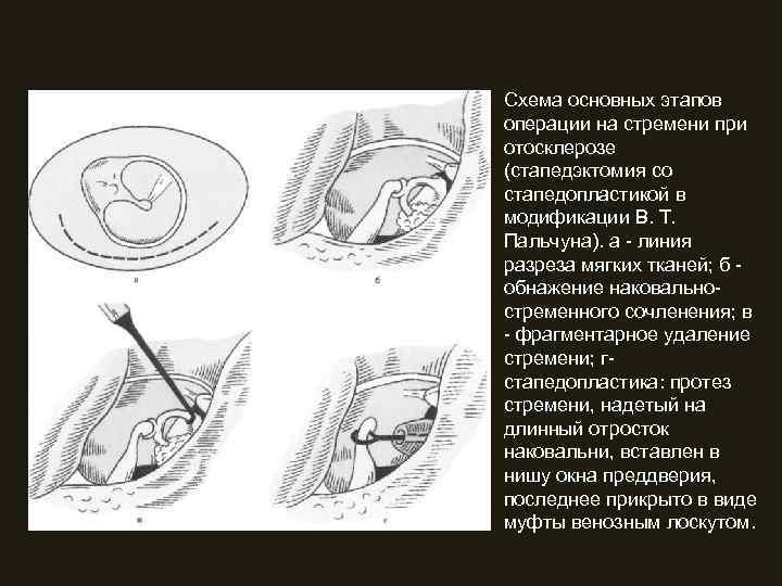Схема основных этапов операции на стремени при отосклерозе (стапедэктомия со стапедопластикой в модификации В.