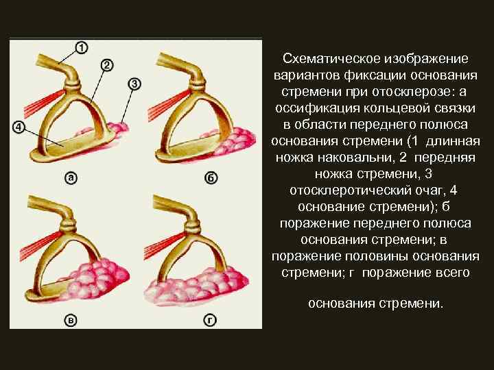  Схематическое изображение вариантов фиксации основания  стремени при отосклерозе: а  оссификация кольцевой