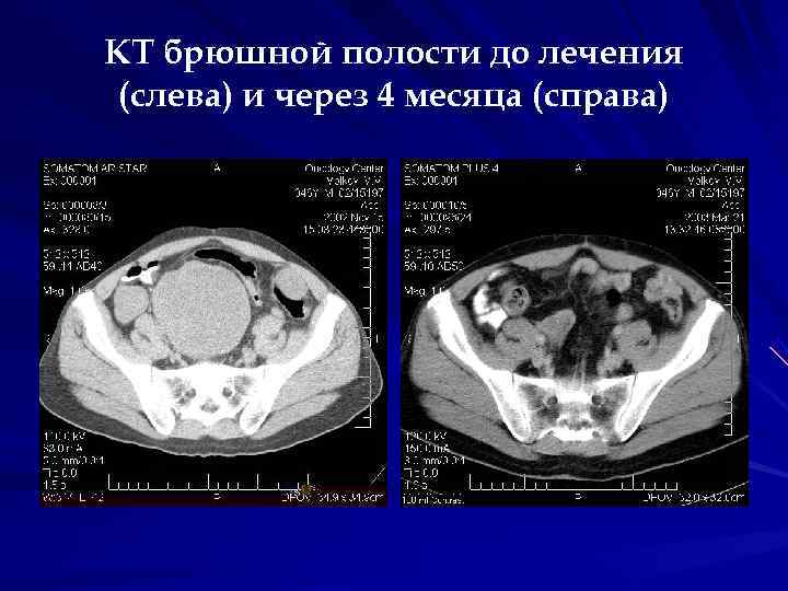 КТ брюшной полости до лечения (слева) и через 4 месяца (справа) КТ брюшной полости до лечения (слева) и через 4 месяца (справа)