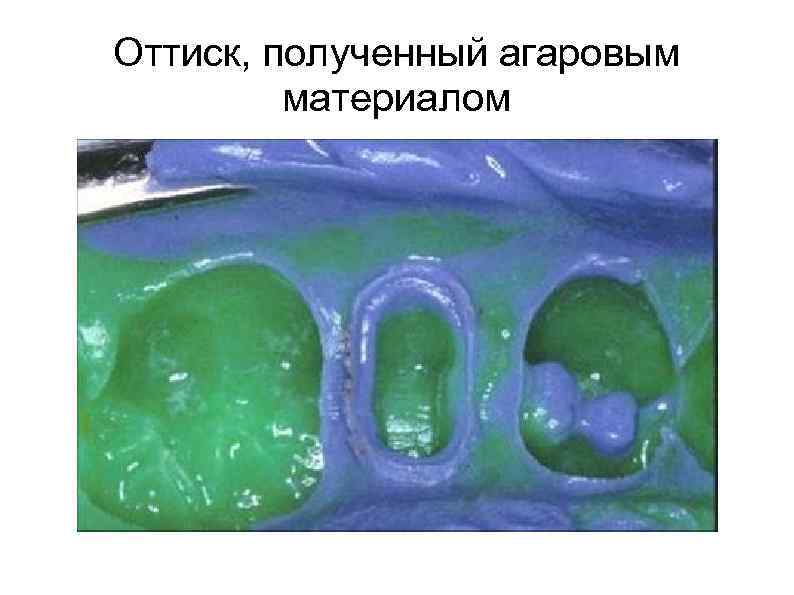 Оттиск, полученный агаровым   материалом 