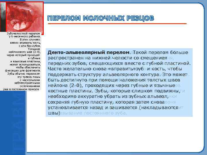  Зубочелюстной перелом   Сложный перелом  у 6 -месячного ребенка.  