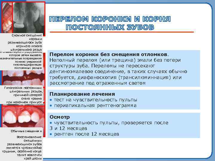    Сложное смещение    Часто     коронки