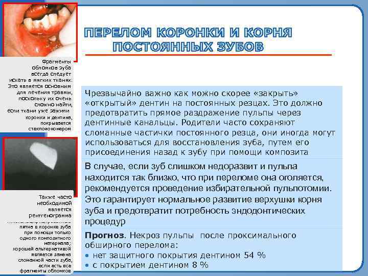  Пломбирование    Фрагменты   фрагмента  обломков зуба  фрактурыследует