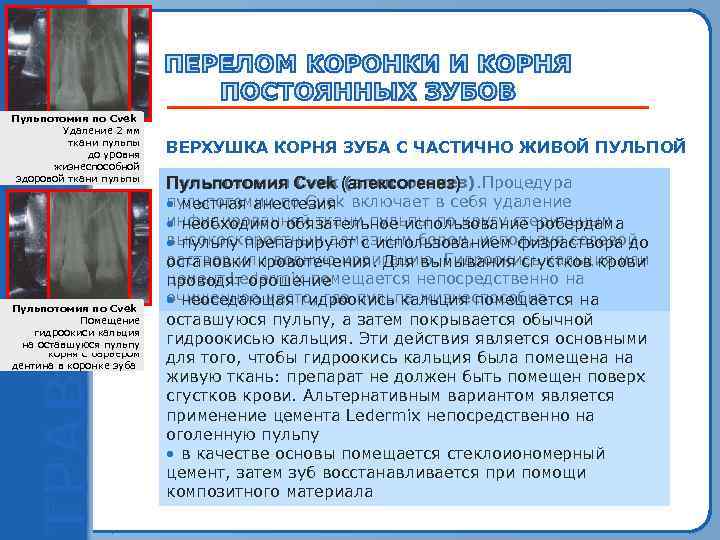 Пульпотомия по Cvek  Оголение пульпы   Удаление 2 мм   молочного