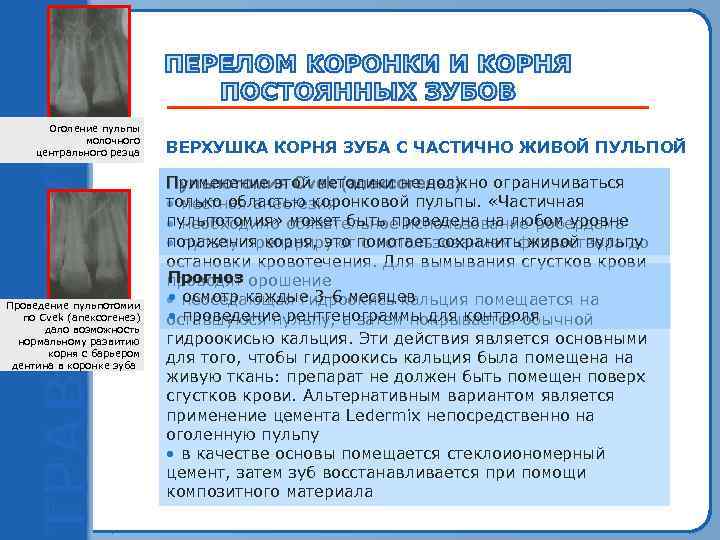   Оголение пульпы   молочного центрального резца  ВЕРХУШКА КОРНЯ ЗУБА С