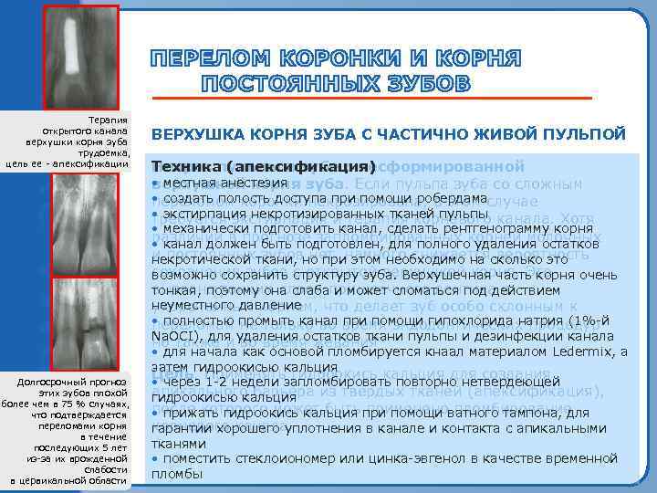    Терапия  открытого канала верхушки корня зуба    