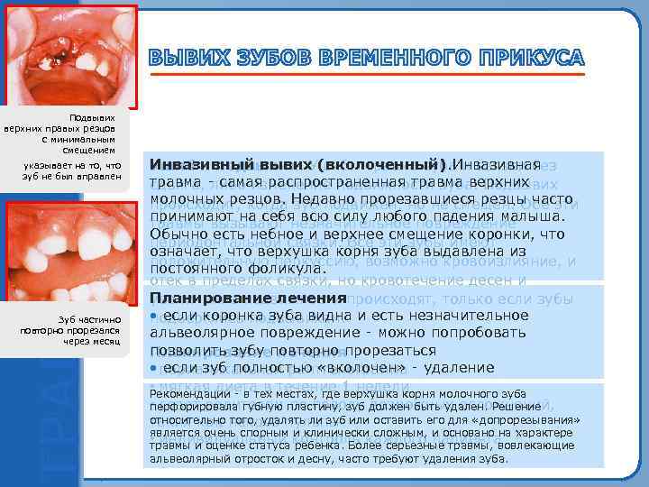    Подвывих  Инвазивный вывих верхних правых резцов верхнего правого резца 