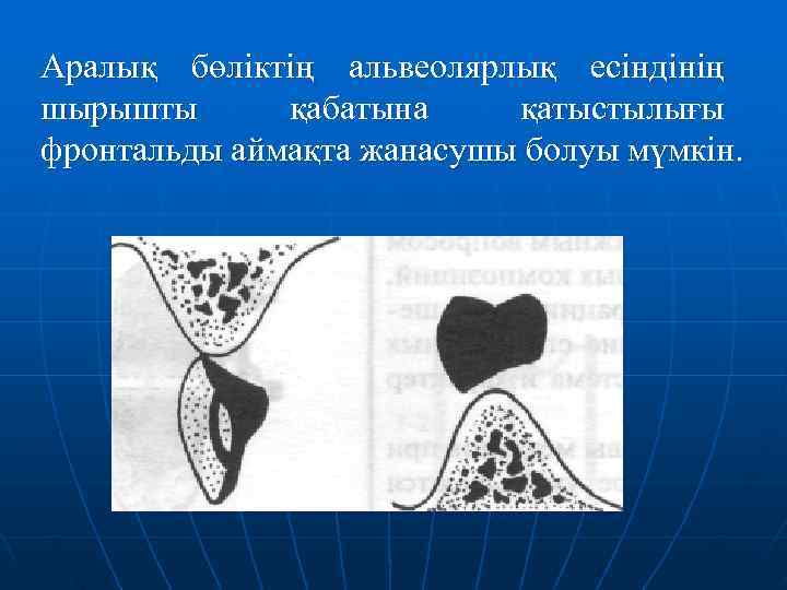 Аралық бөліктің альвеолярлық есіндінің шырышты  қабатына қатыстылығы фронтальды аймақта жанасушы болуы мүмкін. 