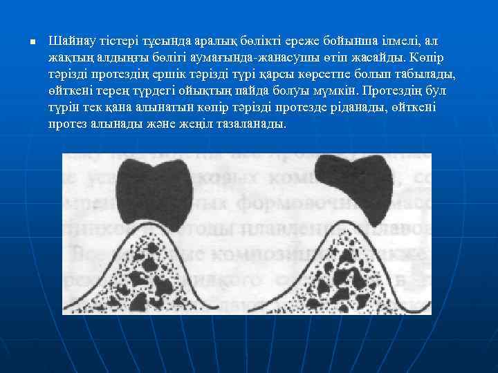 n  Шайнау тістері тұсында аралық бөлікті ереже бойынша ілмелі, ал жақтың алдыңғы бөлігі